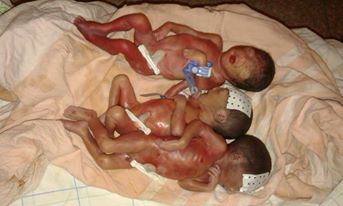 مجزرة الأطفال الخدج بزاكورة تستمر بوفاة أربعة توائم لسيدة من تازارين (1)